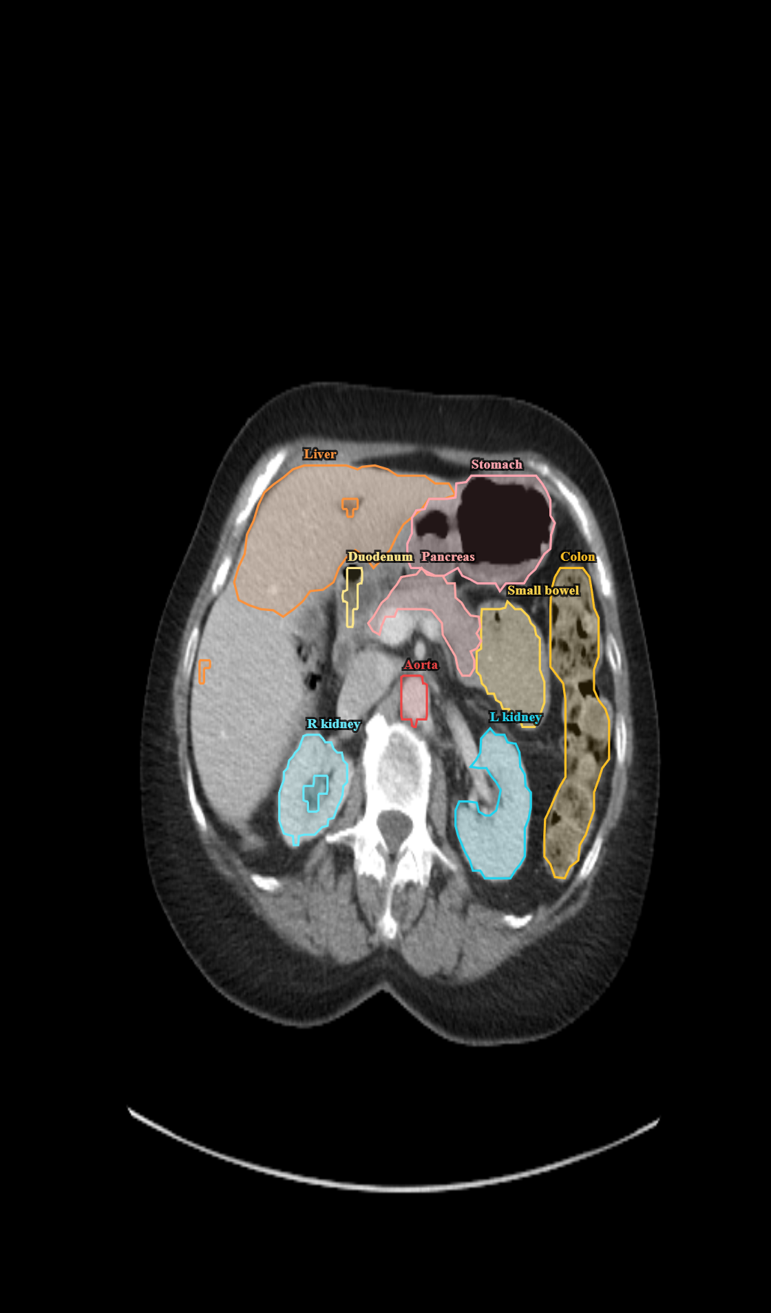 Abdominal CT with organ segmentation