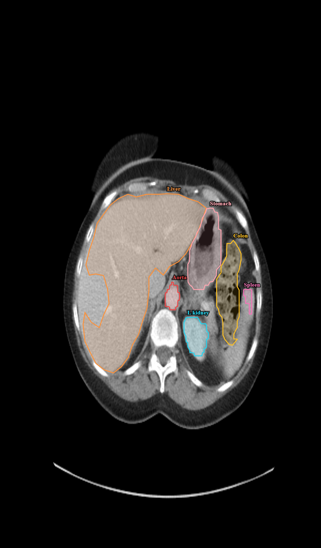 Upper abdomen CT with liver segmentation