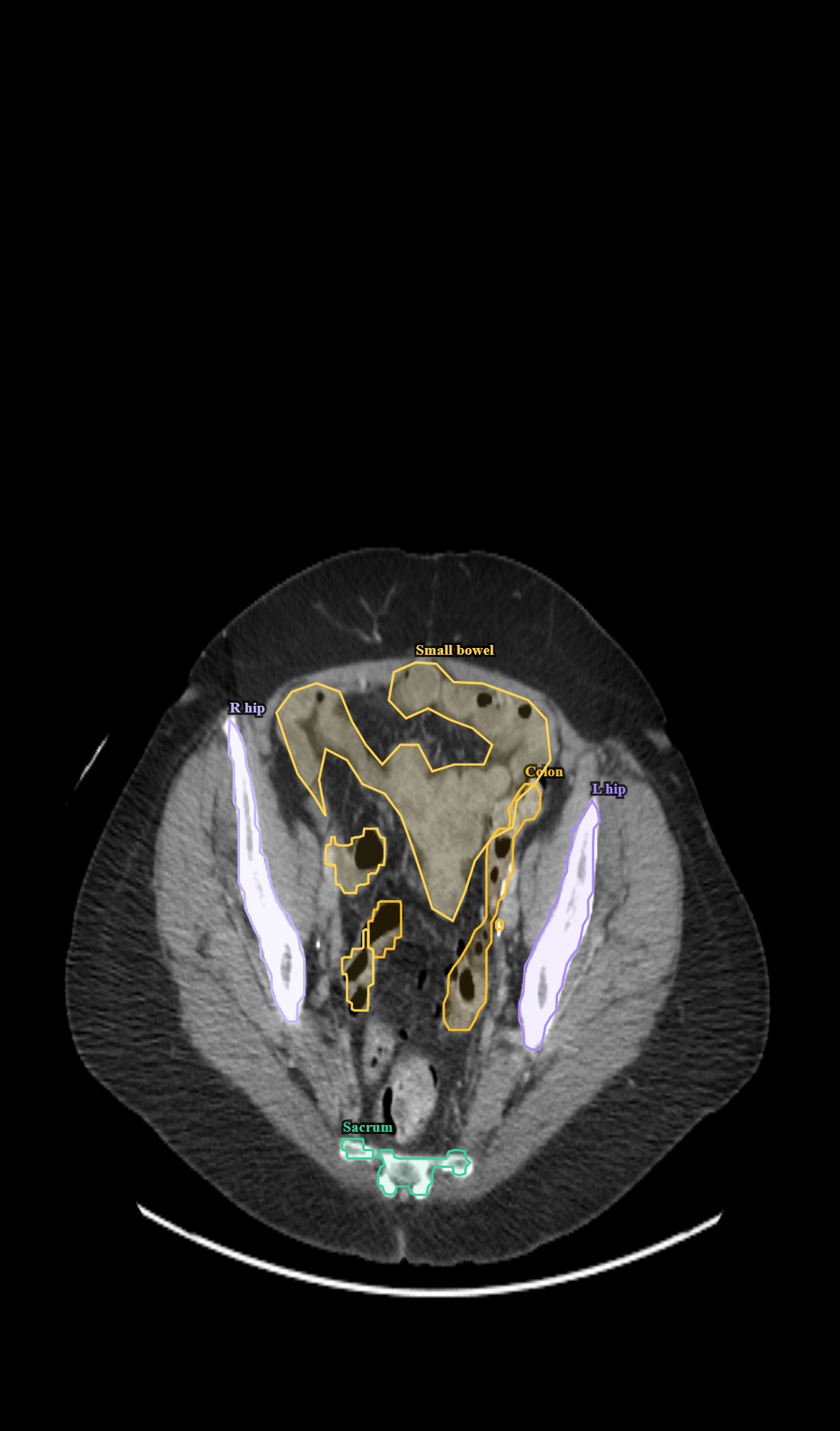 Pelvic CT with skeletal segmentation